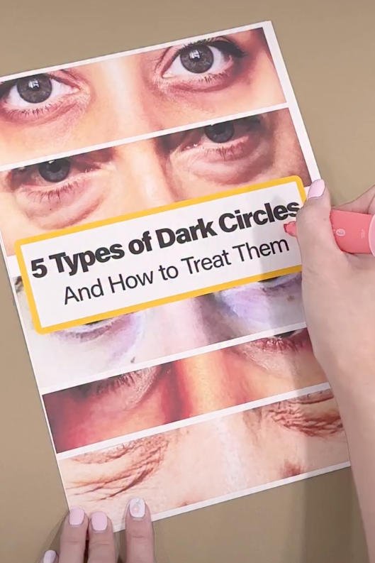 黑眼圈也分種類？對症下藥才能告別熊貓眼！ - Beautitu.com