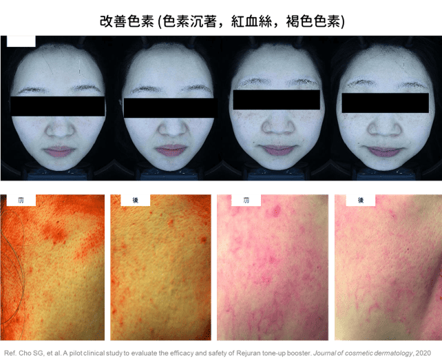 Rejuran 麗珠蘭PDRN白瓷水光效果
