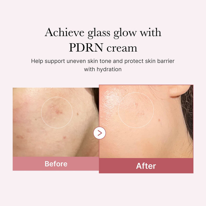 PDRN Pink Hyaluronic Moisturizing Cream Before After